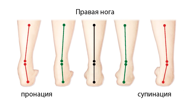 Нейтральная или избыточная пронация и супинация стопы при беге.